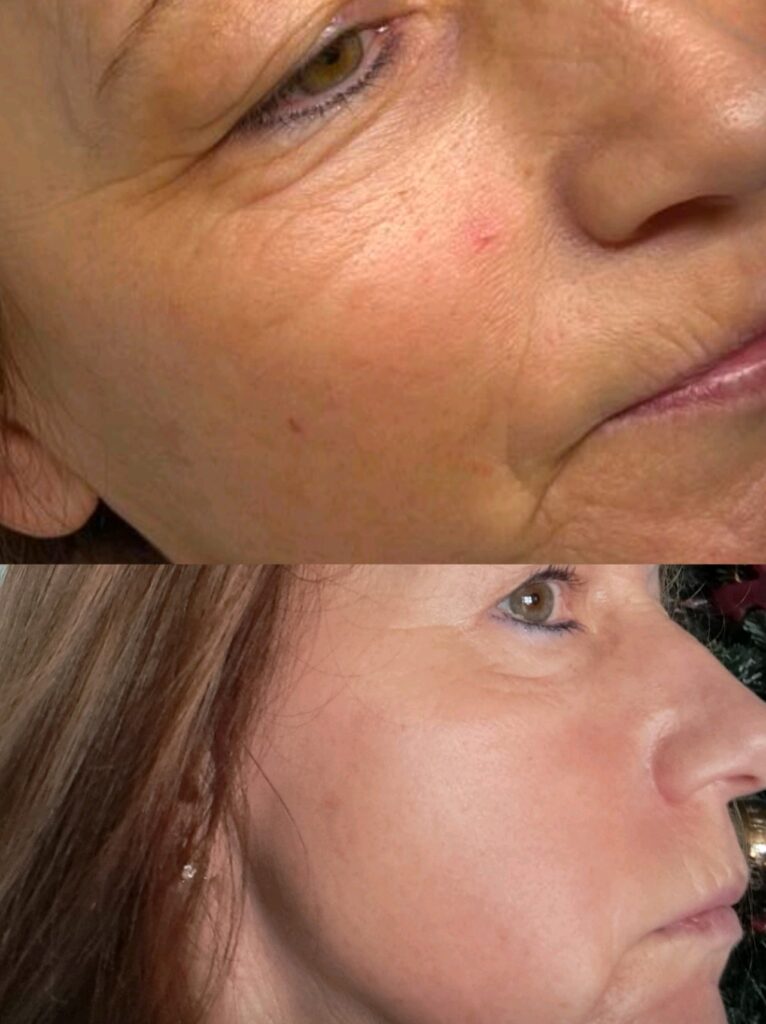 pigmentatie melasma en anti ageing