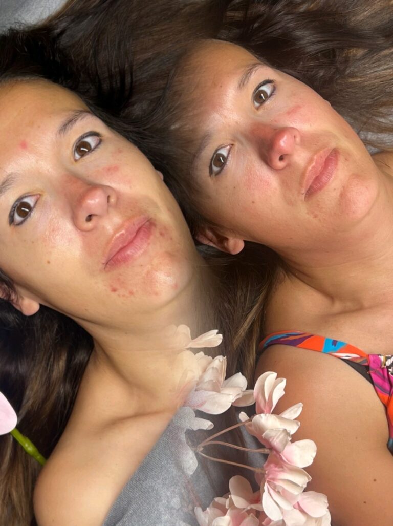 Voor en na afbeelding van hyperpigmentatie behandeling met Dr. Platon Cold Plasma, egalere en stralende teint.